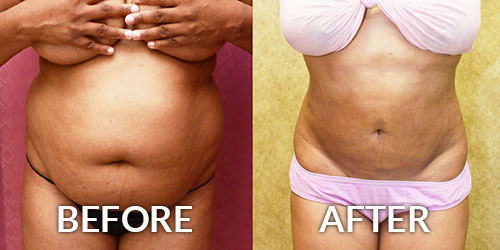 How Much Is A Plus Size Tummy Tuck?