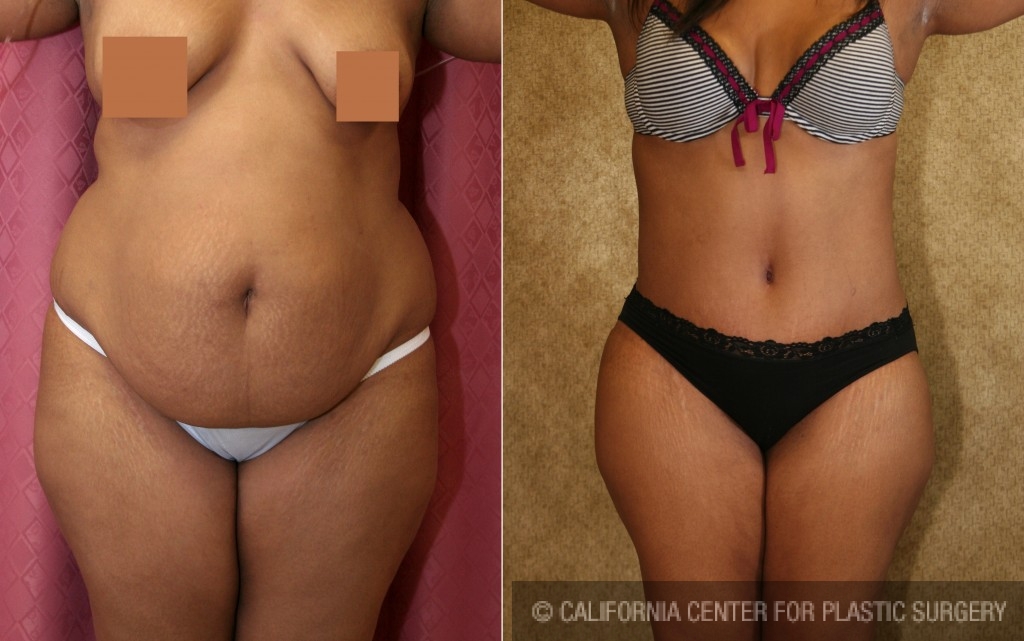 Patient #5957 African American Tummy Tuck (Abdominoplasty) Before