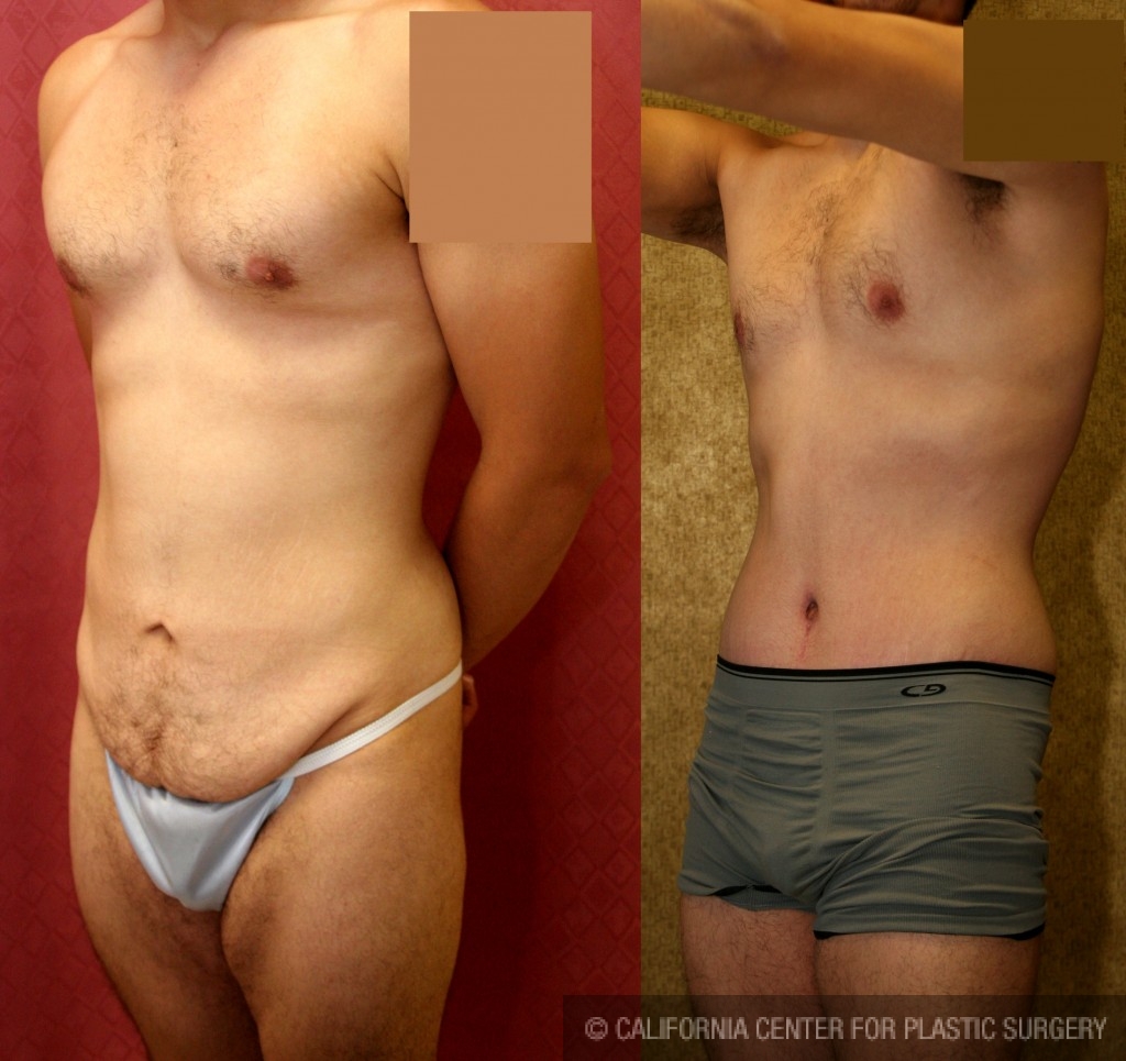 Patient #6009 Male Tummy Tuck (abdominoplasty) Before and After