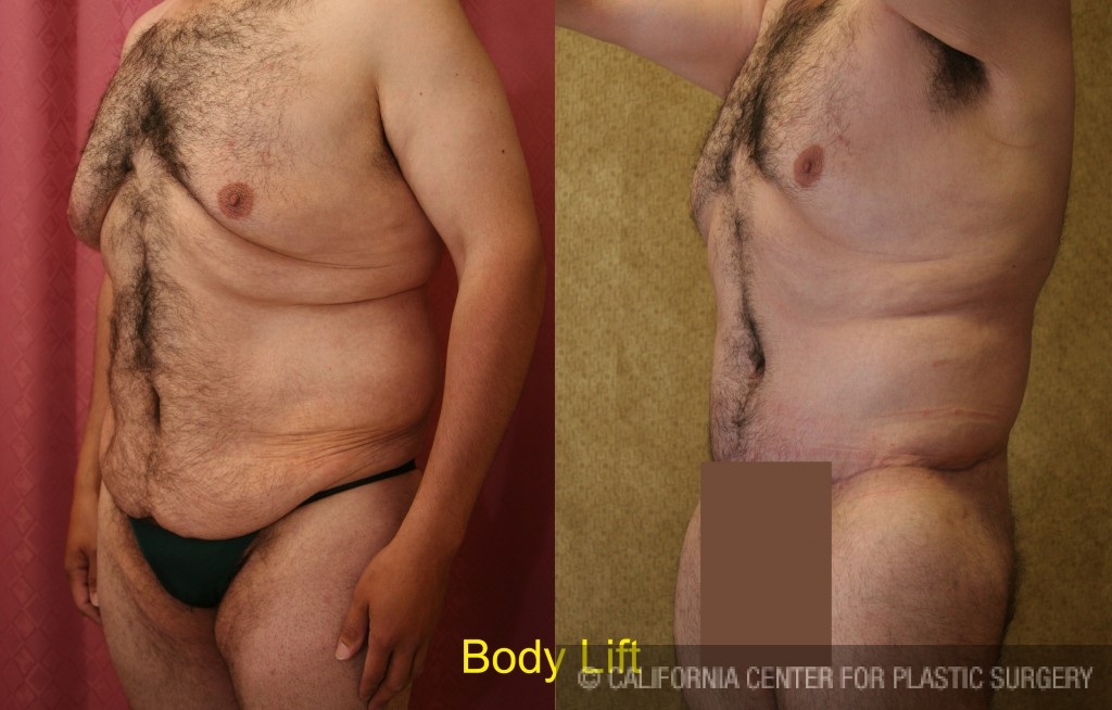 Patient #6023 Male Tummy Tuck (abdominoplasty) Before and After Photos  Encino - Plastic Surgery Gallery Glendale - Dr. Sean Younai