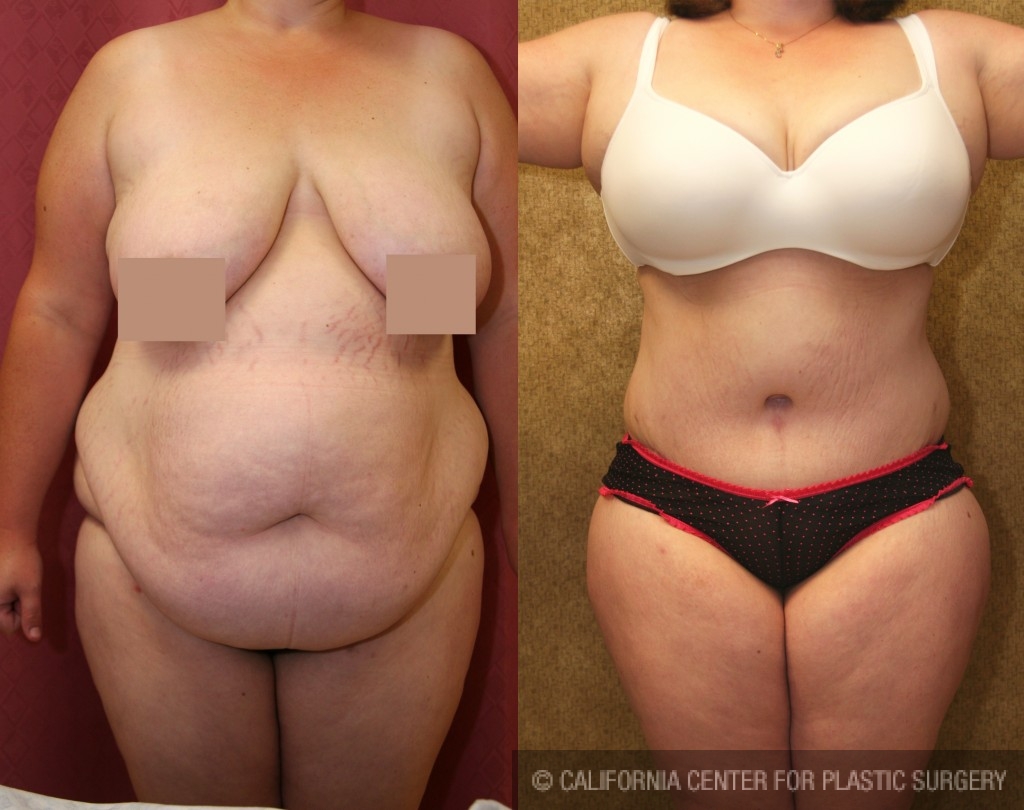 Patient #5894 Tummy Tuck (Abdominoplasty) Plus Size Before and After Photos  Encino - Plastic Surgery Gallery Glendale - Dr. Sean Younai