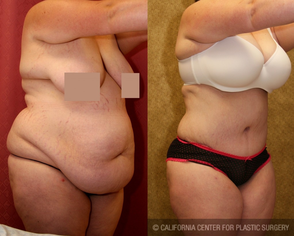 Tummy Tuck (abdominoplasty) Plastic Surgery Before And After Pictures