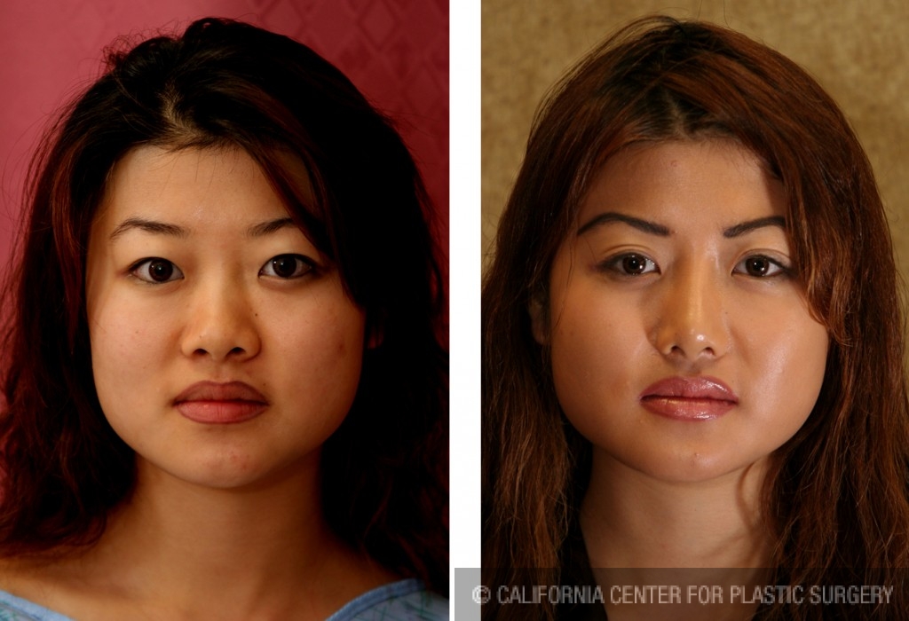 Patient 6394 Asian Rhinoplasty Before And After Photos