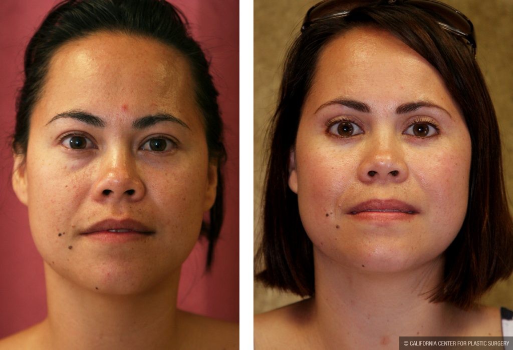 vietnamese plastic surgery before and after
