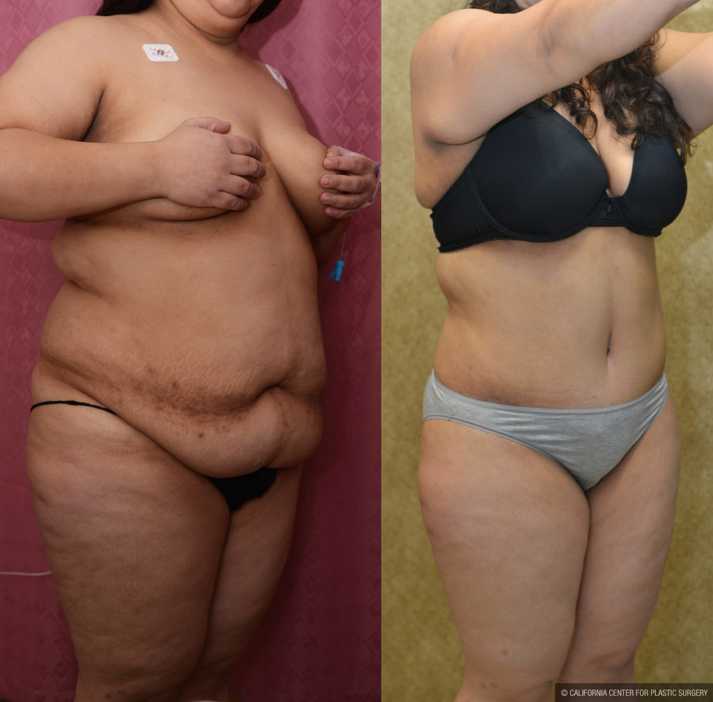Plus Size Tummy Tuck Surgery Before & After Photo Gallery - Patient #47