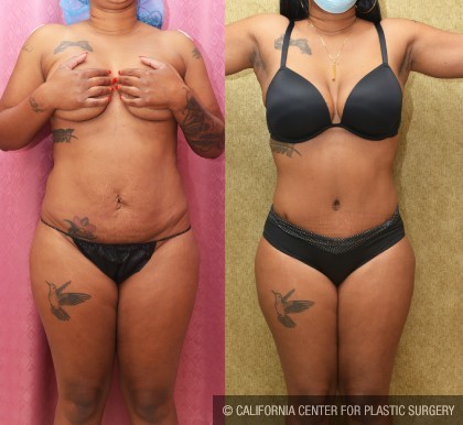Patient #12559 African American Tummy Tuck (Abdominoplasty) Before and  After Photos Encino - Plastic Surgery Gallery Glendale - Dr. Sean Younai