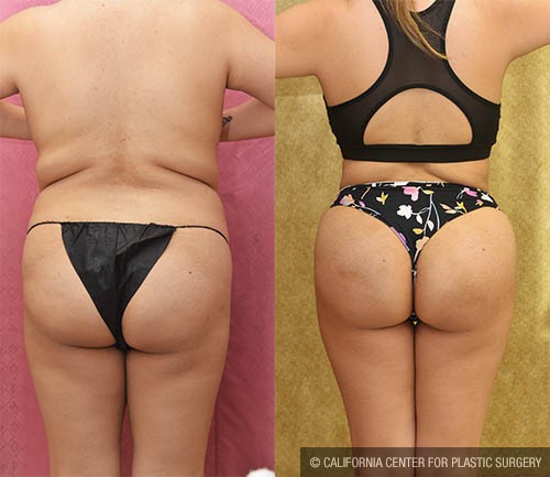 Patient #6116 Buttock Lift/Augmentation Before and After Photos Beverly  Hills - Plastic Surgery Gallery Los Angeles, CA - Dr. Sean Younai