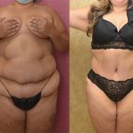 Patient #5715 Liposuction Arms Before and After Photos Beverly Hills -  Plastic Surgery Gallery Los Angeles, CA - Dr. Sean Younai