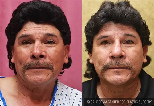 Rhinoplasty - Hispanic Before & After Patient #12817