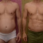Male Liposuction Abdomen Before & After Patient #13125