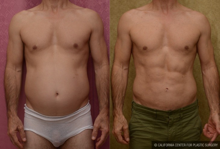 Male Liposuction Abdomen Before & After Patient #13125