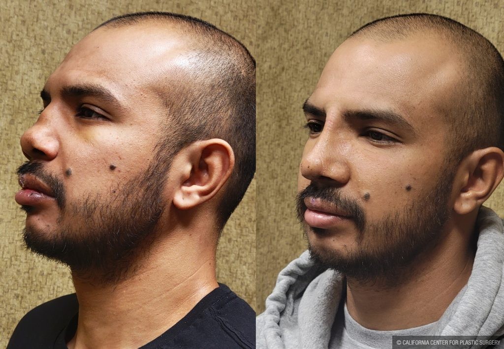 Rhinoplasty - Hispanic Before & After Patient #13137