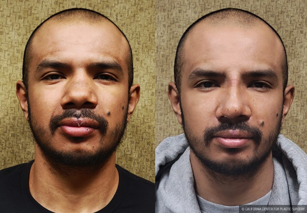 Rhinoplasty - Hispanic Before & After Patient #13137