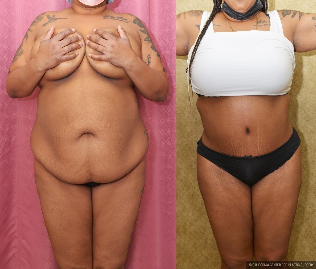 African American Tummy Tuck (Abdominoplasty) Before & After Patient #13108