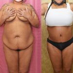 African American Tummy Tuck (Abdominoplasty) Before & After Patient #13108