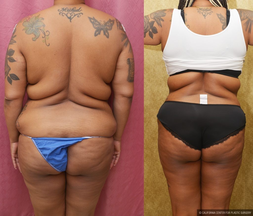 African American Tummy Tuck (Abdominoplasty) Before & After Patient #13108