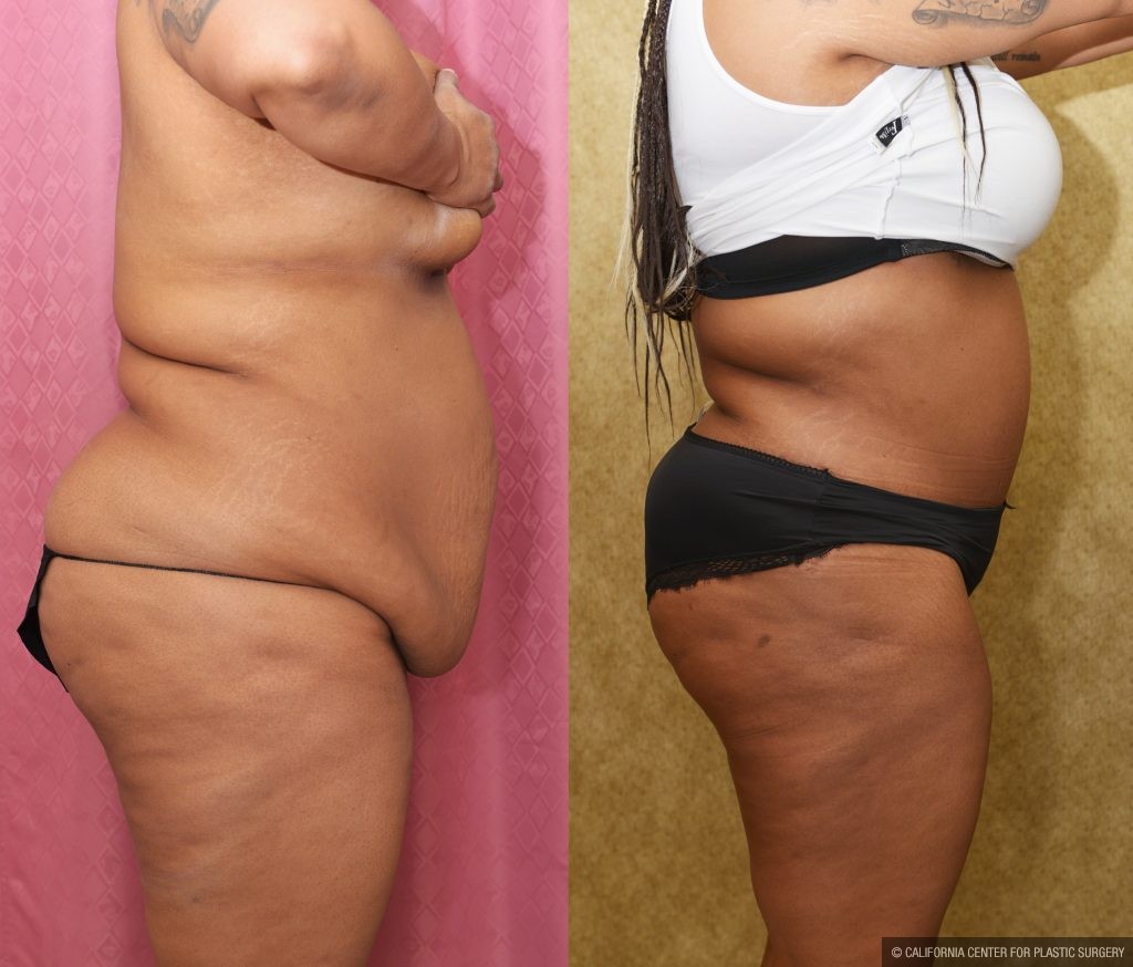 African American Tummy Tuck (Abdominoplasty) Before & After Patient #13108