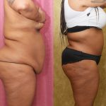 African American Tummy Tuck (Abdominoplasty) Before & After Patient #13108