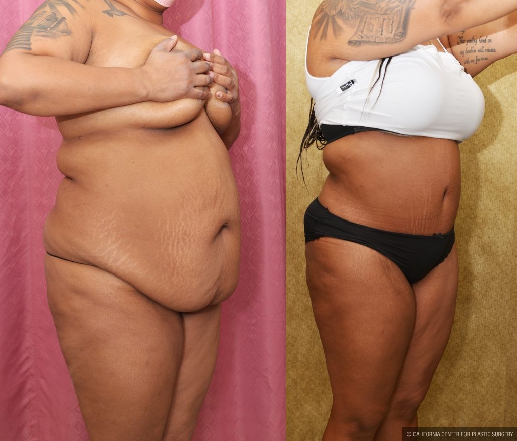 African American Tummy Tuck (Abdominoplasty) Before & After Patient #13108