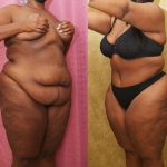 Tummy Tuck (Abdominoplasty) Plus Size Before & After Patient #13112