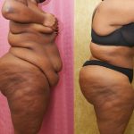 Tummy Tuck (Abdominoplasty) Plus Size Before & After Patient #13112