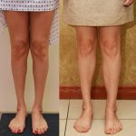 Calf Augmentation Before & After Patient #13123