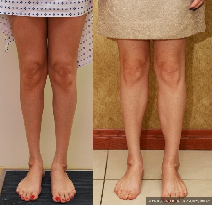 Calf Augmentation Before & After Patient #13123