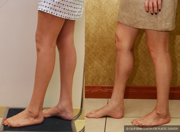 Calf Augmentation Before & After Patient #13123