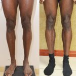 Calf Augmentation Before & After Patient #13122