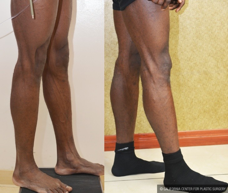 Calf Augmentation Before & After Patient #13122