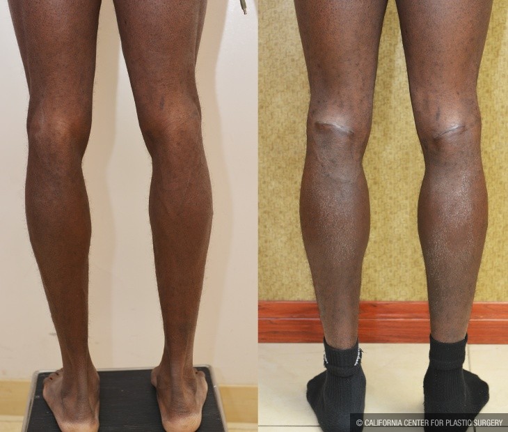 Calf Augmentation Before & After Patient #13122