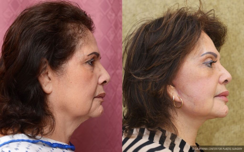 Facelift Before & After Patient #13124