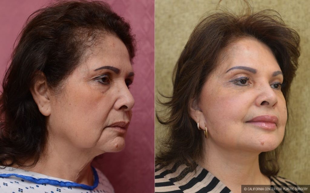 Facelift Before & After Patient #13124