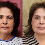 Facelift Before & After Patient #13124
