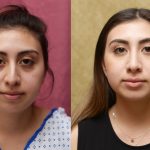 Rhinoplasty - Hispanic Before & After Patient #13141