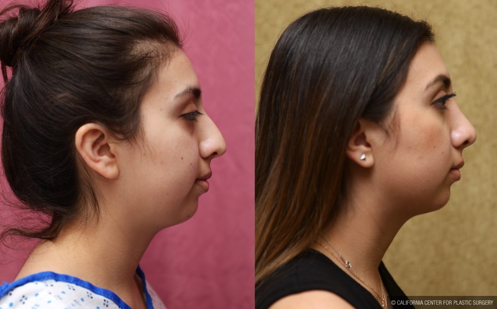 Rhinoplasty - Hispanic Before & After Patient #13141