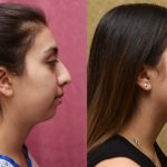 Rhinoplasty - Hispanic Before & After Patient #13141