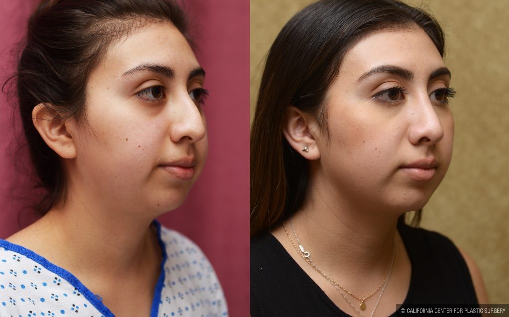 Rhinoplasty - Hispanic Before & After Patient #13141