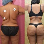 Tummy Tuck (Abdominoplasty) Small Size Before & After Patient #13121