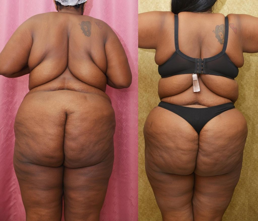 Tummy Tuck (Abdominoplasty) Plus Size Before & After Patient #13112