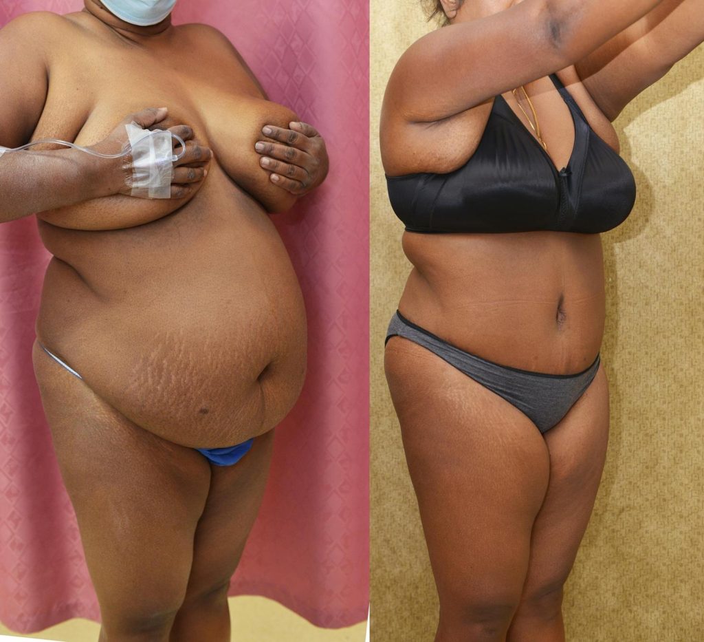 African American Tummy Tuck (Abdominoplasty) Before & After Patient #13120