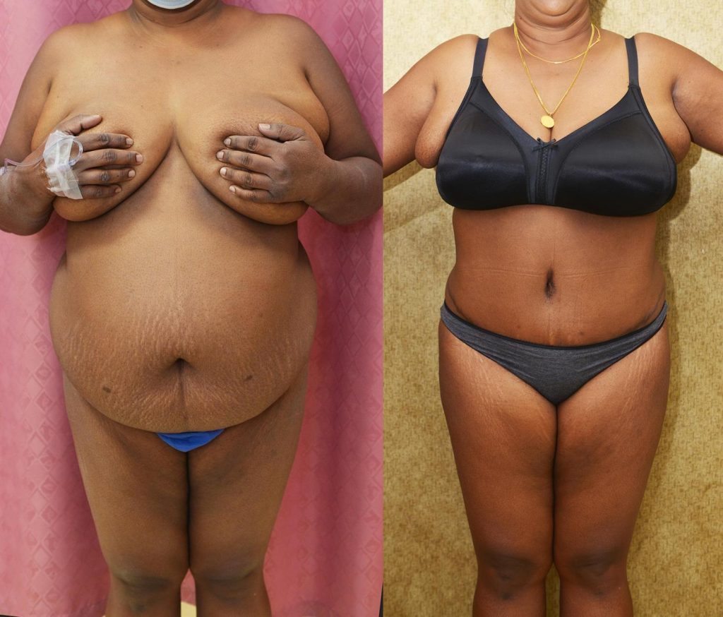 African American Tummy Tuck (Abdominoplasty) Before & After Patient #13120