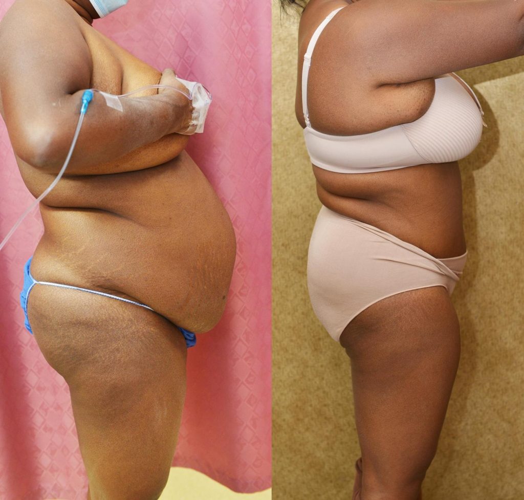 African American Tummy Tuck (Abdominoplasty) Before & After Patient #13120