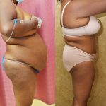 African American Tummy Tuck (Abdominoplasty) Before & After Patient #13120