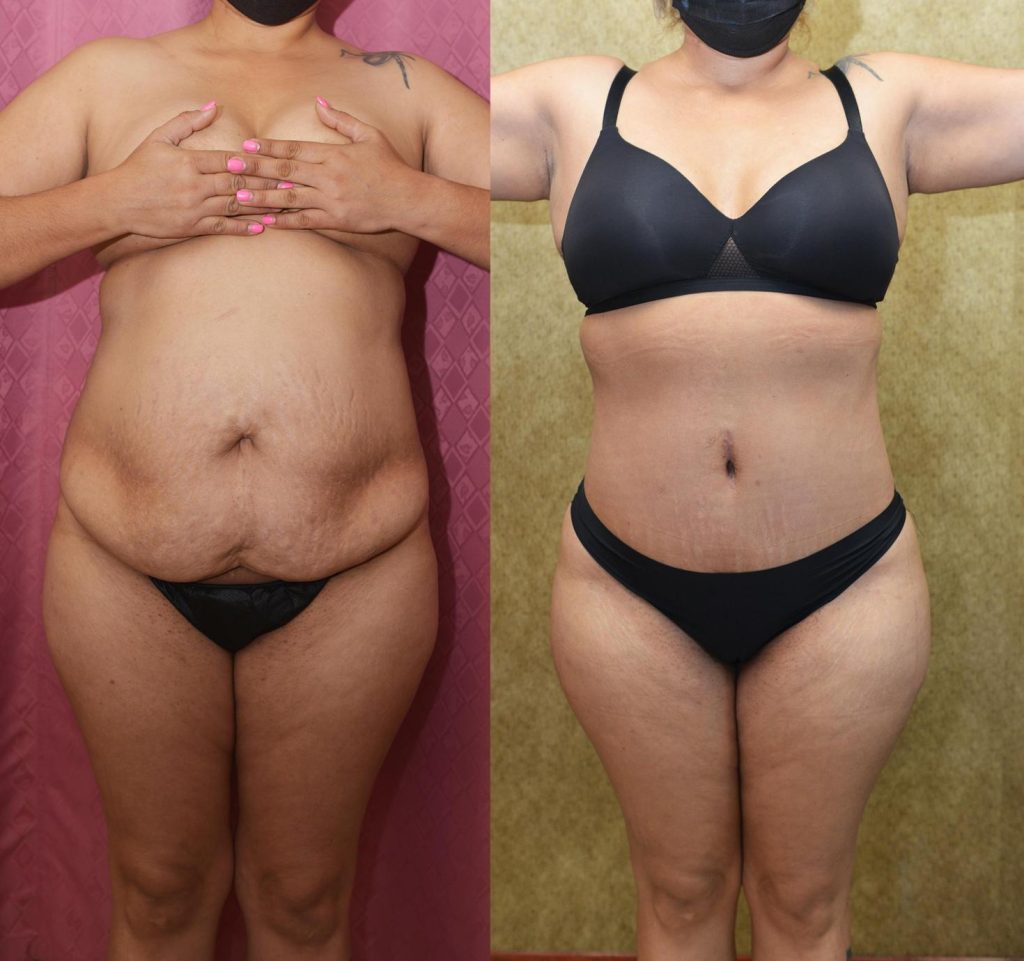 Tummy Tuck (Abdominoplasty) Small Size Before & After Patient #13107