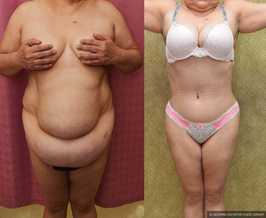 Tummy Tuck (Abdominoplasty) Plus Size Before & After Patient #13168