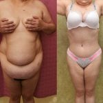 Tummy Tuck (Abdominoplasty) Plus Size Before & After Patient #13168