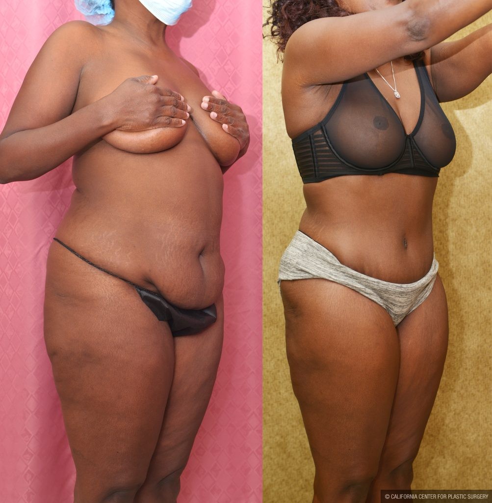 African American Tummy Tuck (Abdominoplasty) Before & After Patient #13169