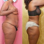 African American Tummy Tuck (Abdominoplasty) Before & After Patient #13169