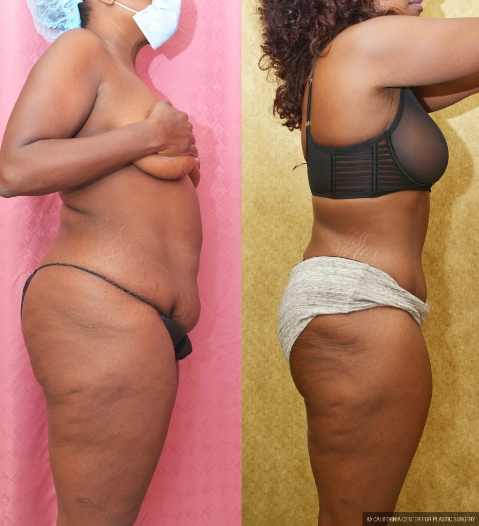 African American Tummy Tuck (Abdominoplasty) Before & After Patient #13169